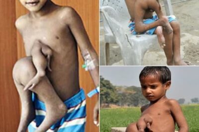 In Bihar, India, Deepak Paswaan was born after a grueling pregnancy, his mother expecting twins. Only one survived—Deepak—carrying his underdeveloped twin’s four extra arms and legs fused to his torso. Mocked as a “freak” and “The Eight-Limbed Boy,” the 7-year-old endured cruel taunts. His poor family couldn’t afford the surgery to free him from his parasitic twin. But…